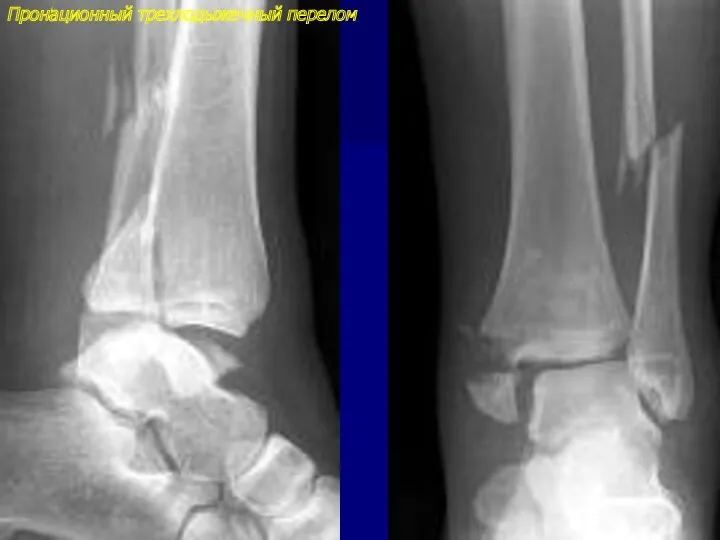 Пронационный трехлодыжечный перелом