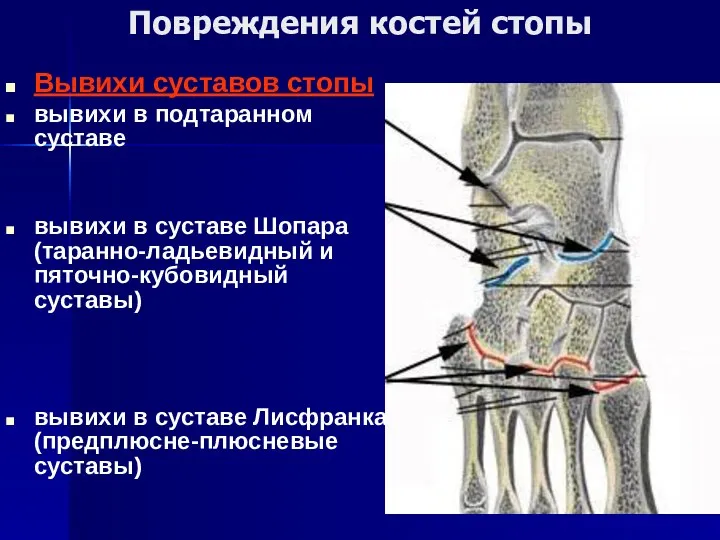 Повреждения костей стопы Вывихи суставов стопы вывихи в подтаранном суставе