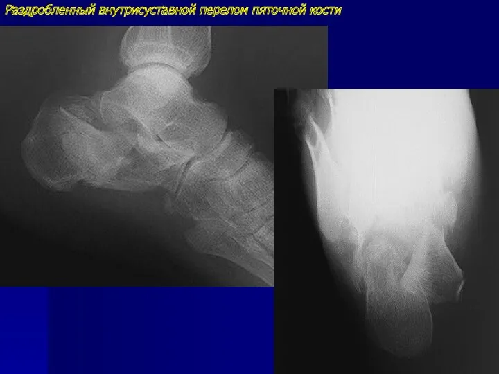 Раздробленный внутрисуставной перелом пяточной кости