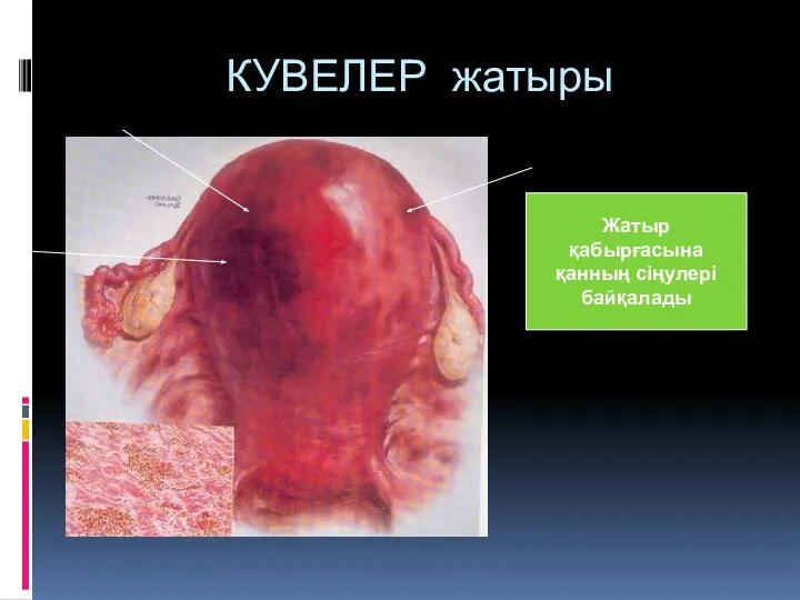 КУВЕЛЕР жатыры Жатыр қабырғасына қанның сіңулері байқалады