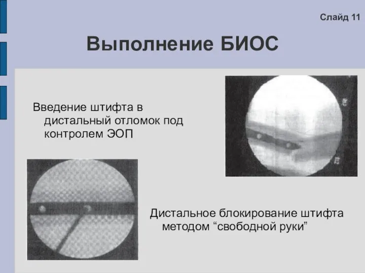 Выполнение БИОС Введение штифта в дистальный отломок под контролем ЭОП Дистальное блокирование штифта