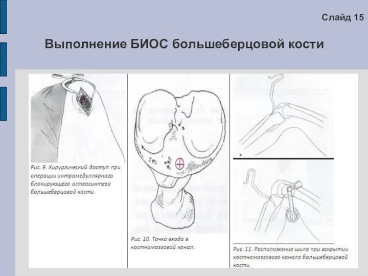 Выполнение БИОС большеберцовой кости Слайд 15