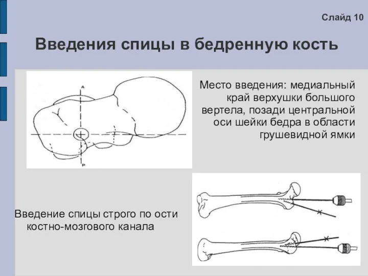 Введения спицы в бедренную кость Место введения: медиальный край верхушки большого вертела, позади