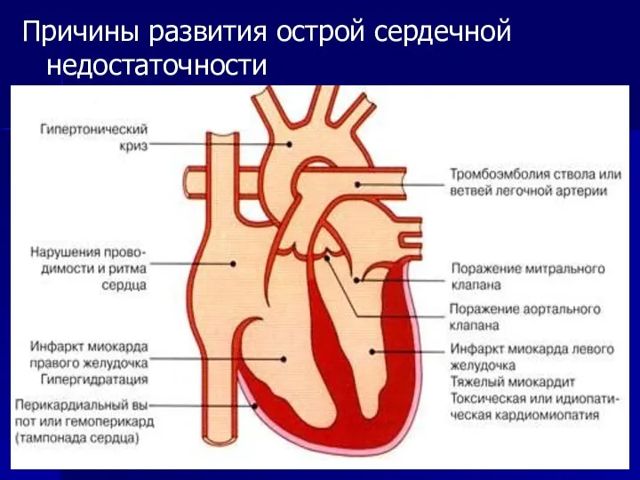 Причины развития острой сердечной недостаточности