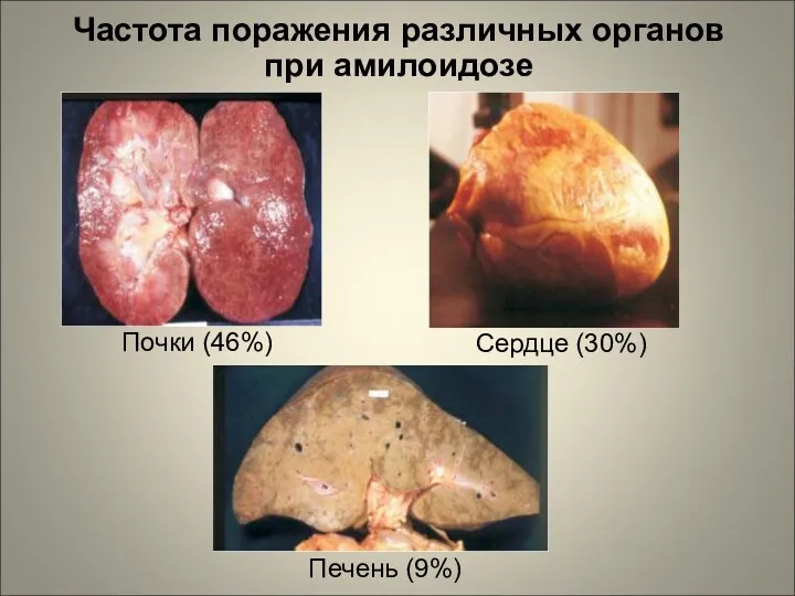 Частота поражения различных органов при амилоидозе Почки (46%) Сердце (30%) Печень (9%)