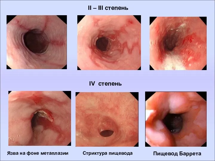 IV степень Язва на фоне метаплазии Стриктура пищевода Пищевод Баррета II – III степень