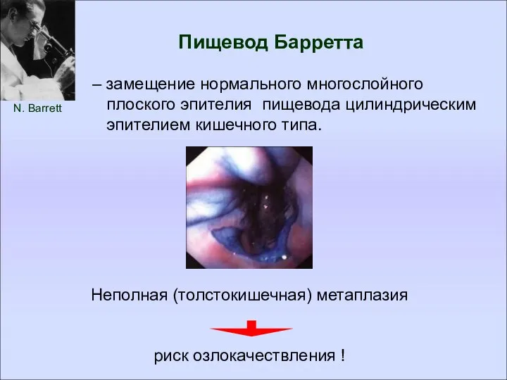 Пищевод Барретта N. Barrett – замещение нормального многослойного плоского эпителия