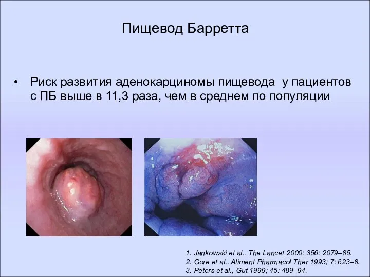 1. Jankowski et al., The Lancet 2000; 356: 2079–85. 2.