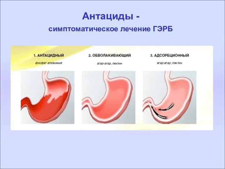 Антациды - симптоматическое лечение ГЭРБ