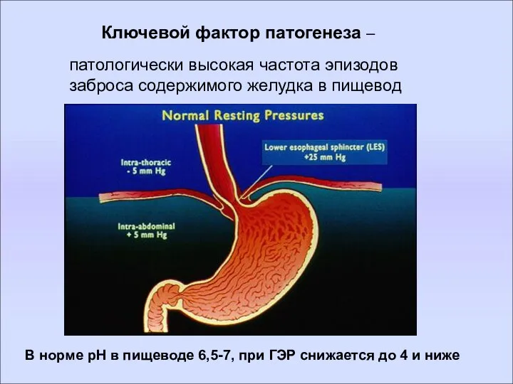 Ключевой фактор патогенеза – патологически высокая частота эпизодов заброса содержимого желудка в пищевод