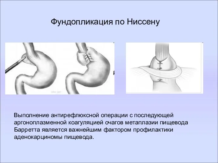 Фундопликация по Ниссену Выполнение антирефлюксной операции с последующей аргоноплазменной коагуляцией