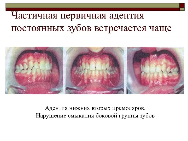 Частичная первичная адентия постоянных зубов встречается чаще Адентия нижних вторых премоляров. Нарушение смыкания боковой группы зубов
