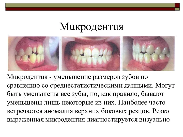 Мuкродентuя - уменьшение размеров зубов по сравнению со среднестатистическими данными.