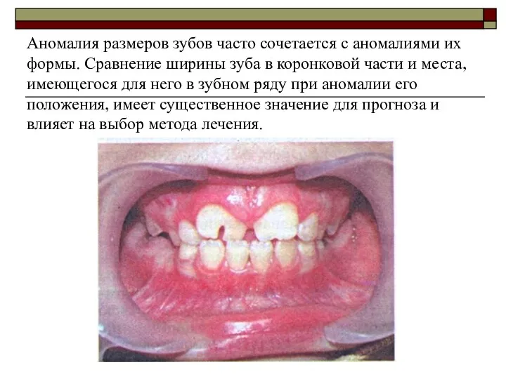 Аномалия размеров зубов часто сочетается с аномалиями их формы. Сравнение