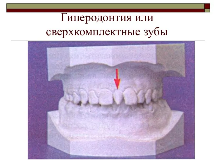 Гиперодонтия или сверхкомплектные зубы