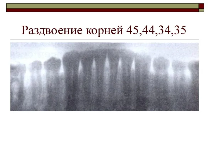 Раздвоение корней 45,44,34,35