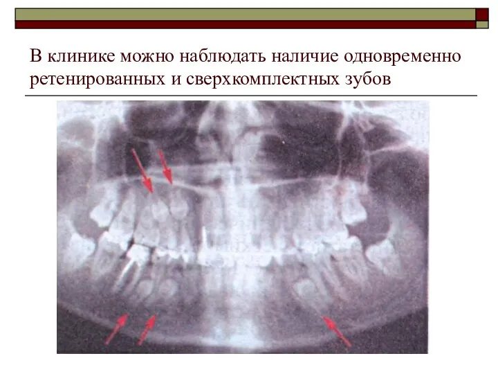 В клинике можно наблюдать наличие одновременно ретенированных и сверхкомплектных зубов
