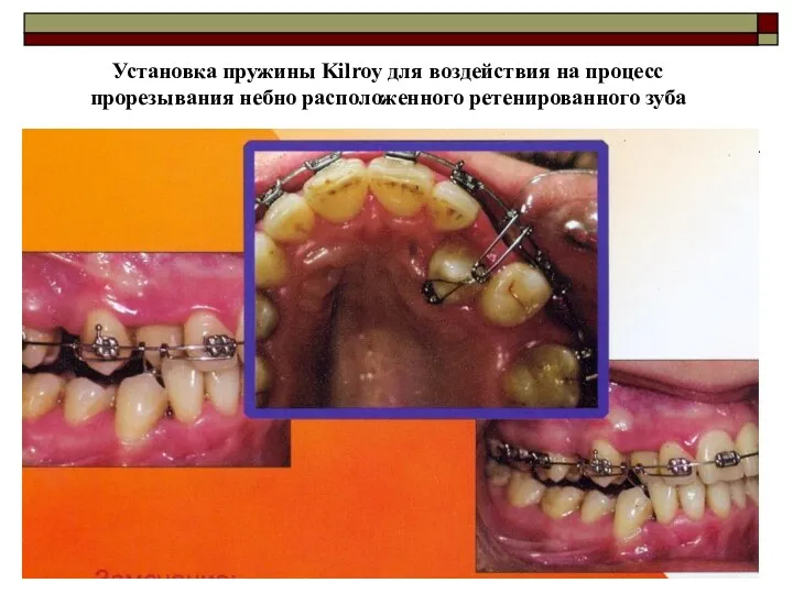 Установка пружины Kilroy для воздействия на процесс прорезывания небно расположенного ретенированного зуба