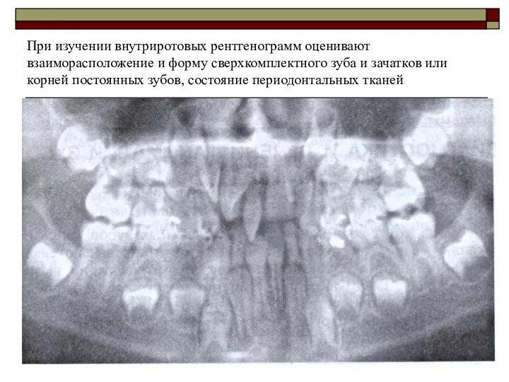 При изучении внутриротовых рентгенограмм оценивают взаиморасположение и форму сверхкомплектного зуба