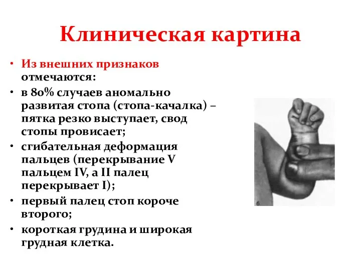 Клиническая картина Из внешних признаков отмечаются: в 80% случаев аномально