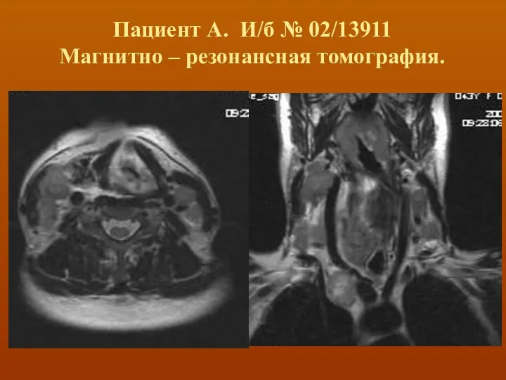 Пациент А. И/б № 02/13911 Магнитно – резонансная томография.