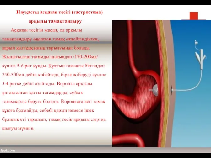 Науқасты асқазан тесігі (гастростома) арқылы тамақтандыру Асқазан тесігін жасап, ол