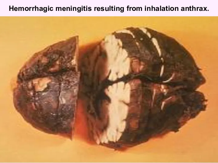 Hemorrhagic meningitis resulting from inhalation anthrax.