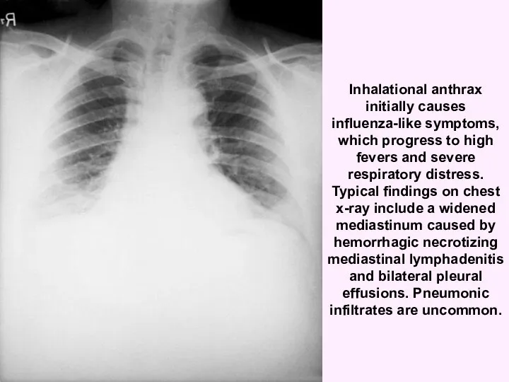 Inhalational anthrax initially causes influenza-like symptoms, which progress to high