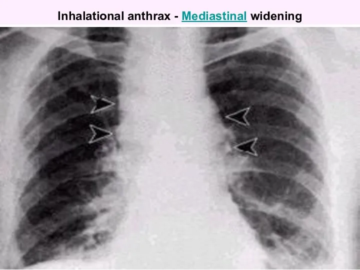 Inhalational anthrax - Mediastinal widening