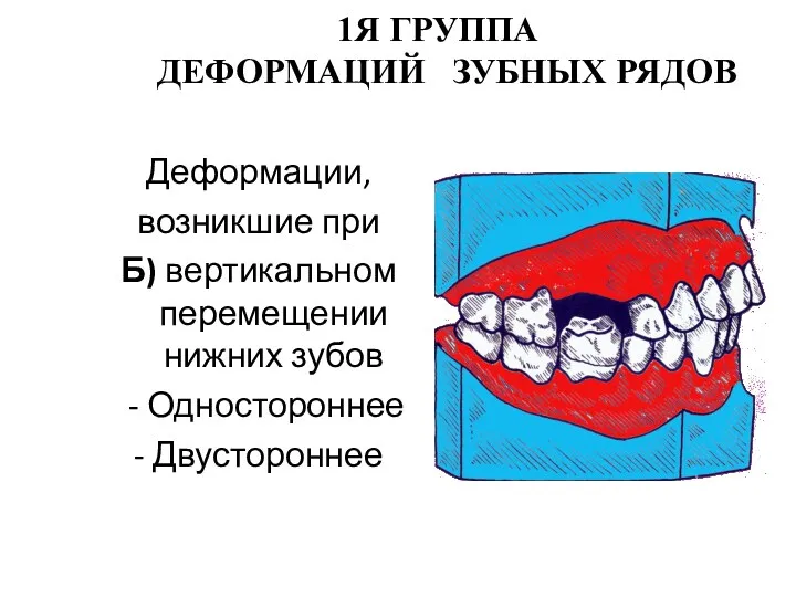 1Я ГРУППА ДЕФОРМАЦИЙ ЗУБНЫХ РЯДОВ Деформации, возникшие при Б) вертикальном перемещении нижних зубов