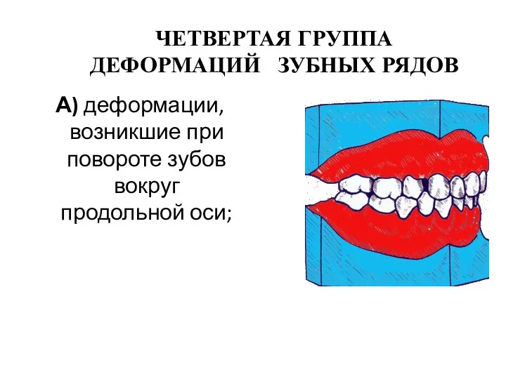 ЧЕТВЕРТАЯ ГРУППА ДЕФОРМАЦИЙ ЗУБНЫХ РЯДОВ А) деформации, возникшие при повороте зубов вокруг продольной оси;
