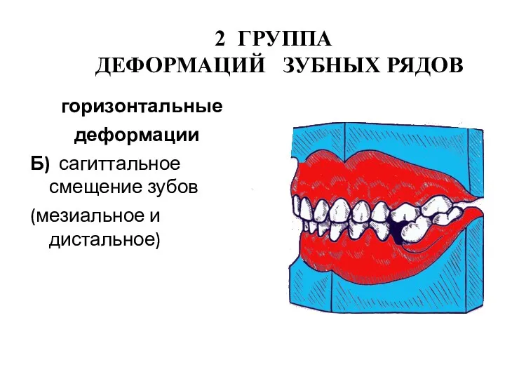 2 ГРУППА ДЕФОРМАЦИЙ ЗУБНЫХ РЯДОВ горизонтальные деформации Б) сагиттальное смещение зубов (мезиальное и дистальное)
