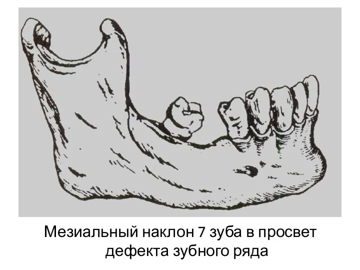 Мезиальный наклон 7 зуба в просвет дефекта зубного ряда