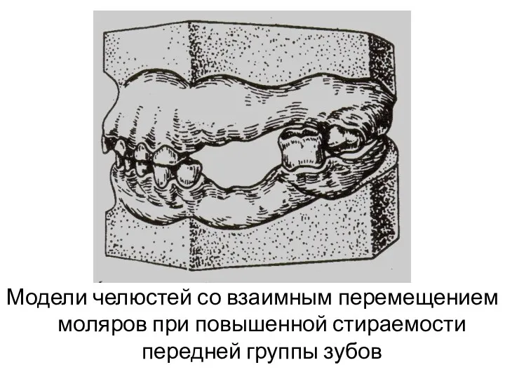 Модели челюстей со взаимным перемещением моляров при повышенной стираемости передней группы зубов