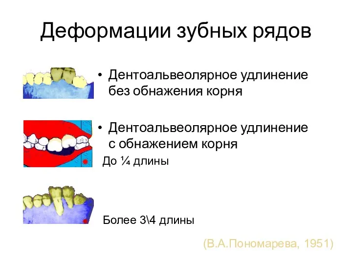 Деформации зубных рядов Дентоальвеолярное удлинение без обнажения корня Дентоальвеолярное удлинение с обнажением корня