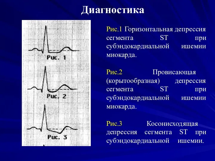 Диагностика Рис.1 Горизонтальная депрессия сегмента SТ при субэндокардиальной ишемии миокарда.