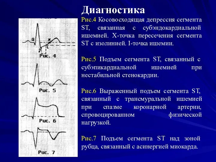 Диагностика Рис.4 Косовосходящая депрессия сегмента SТ, связанная с субэндокардиальной ишемией.