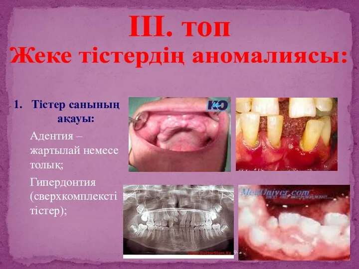 1. Тістер санының ақауы: Адентия – жартылай немесе толық; Гипердонтия