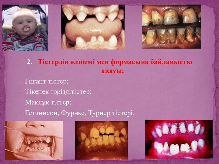 2. Тістердің өлшемі мен формасына байланысты ақауы; Гигант тістер; Тікенек