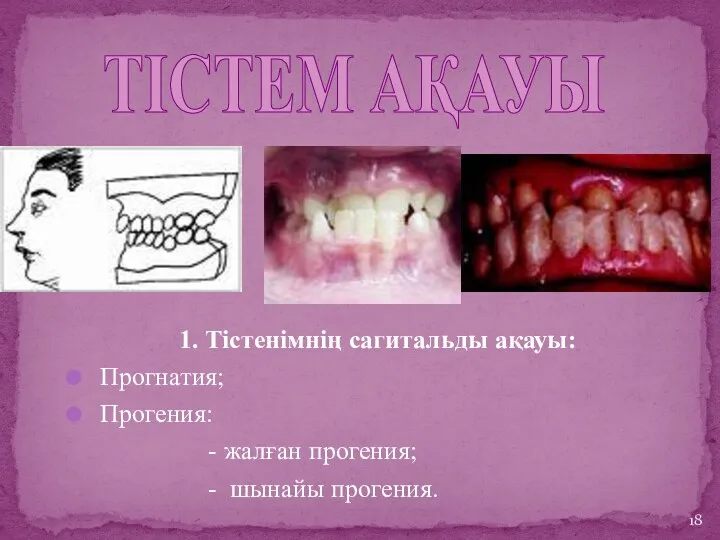 1. Тістенімнің сагитальды ақауы: Прогнатия; Прогения: - жалған прогения; - шынайы прогения. ТІСТЕМ АҚАУЫ