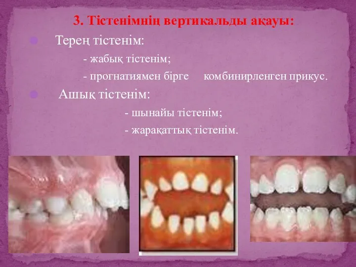 3. Тістенімнің вертикальды ақауы: Терең тістенім: - жабық тістенім; -