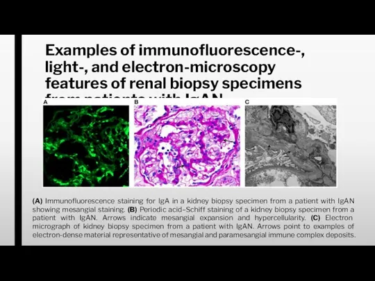 Examples of immunofluorescence-, light-, and electron-microscopy features of renal biopsy