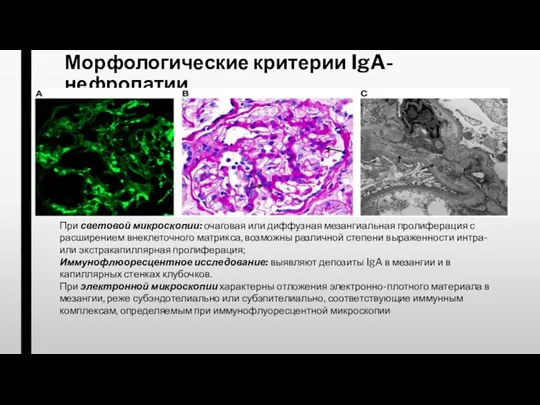 Морфологические критерии IgA-нефропатии При световой микроскопии: очаговая или диффузная мезангиальная