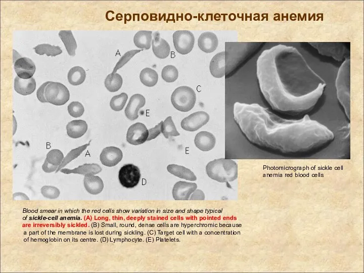 Blood smear in which the red cells show variation in