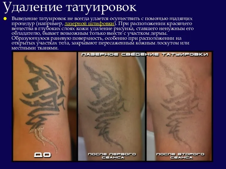 Выведение татуировок не всегда удается осуществить с помощью щадящих процедур (например, лазерной шлифовки).