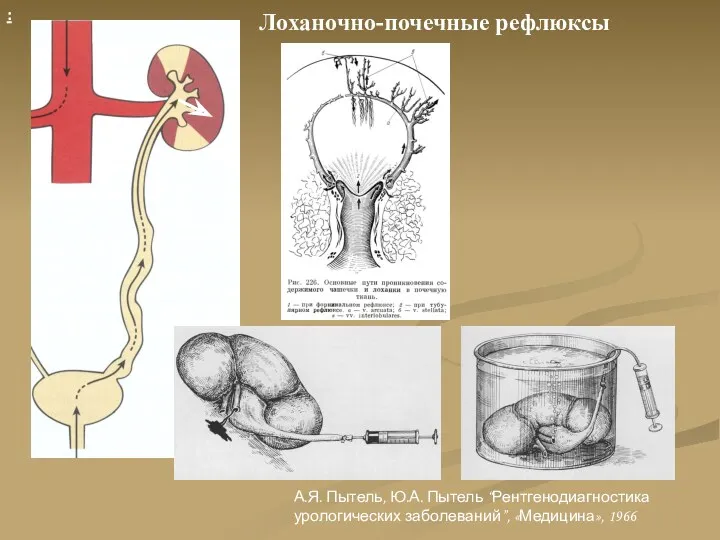 : Лоханочно-почечные рефлюксы А.Я. Пытель, Ю.А. Пытель “Рентгенодиагностика урологических заболеваний”, «Медицина», 1966