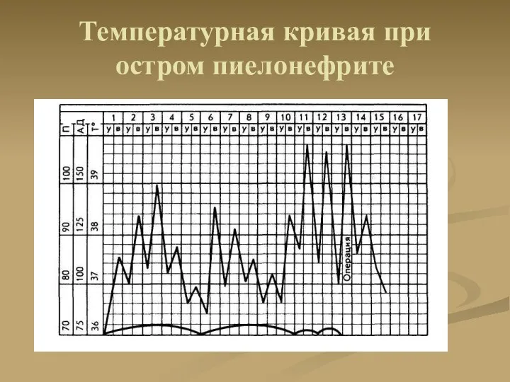 Температурная кривая при остром пиелонефрите