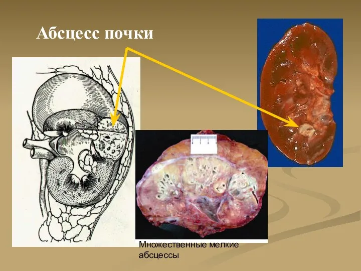 Абсцесс почки Множественные мелкие абсцессы