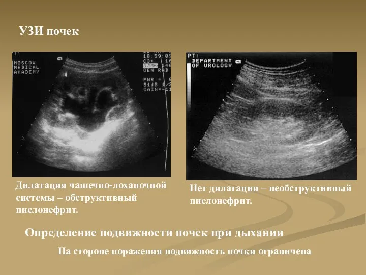 УЗИ почек Дилатация чашечно-лоханочной системы – обструктивный пиелонефрит. Нет дилатации