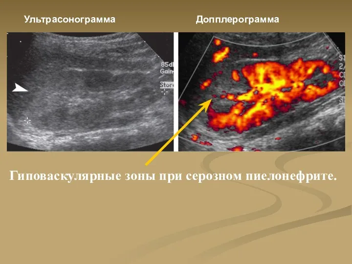 Гиповаскулярные зоны при серозном пиелонефрите. Ультрасонограмма Допплерограмма